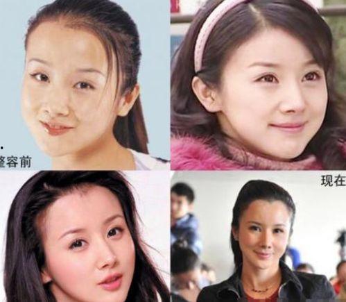 明星整容失败吗,美丽背后的代价
